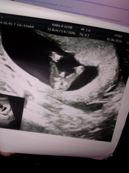 Беременность 12 недель мальчик. УЗИ 13 недель беременности мальчик. Фото УЗИ 12-13 недель беременности. УЗИ 12 недель беременности. УЗИ 12 недель беременности мальчик.